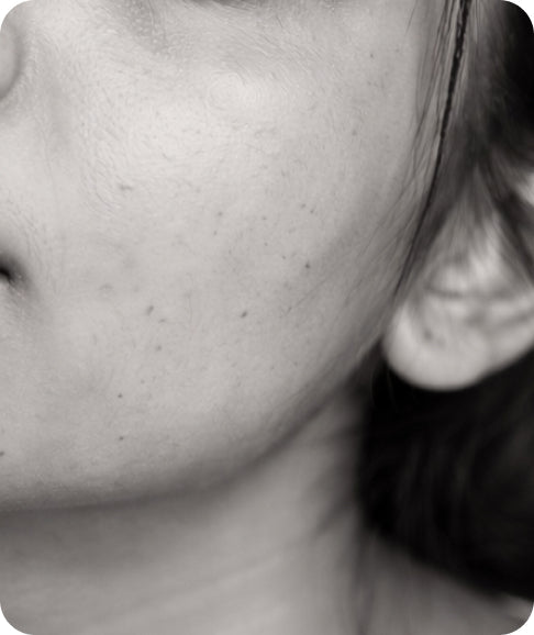 Pigmentation, Tan & Uneven Tone