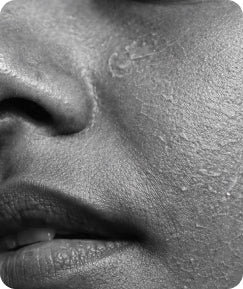 Dry & Dehydrated Skin